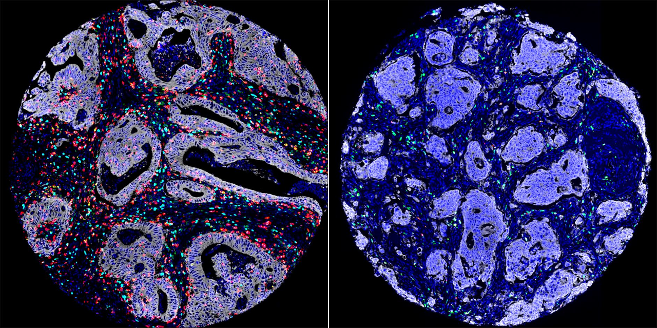 Biosensor image of colorectal cancer.